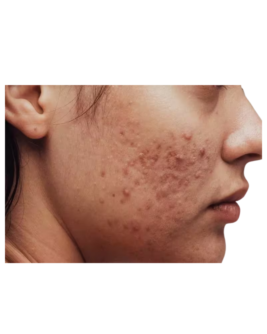 ACTIVE PIMPLES