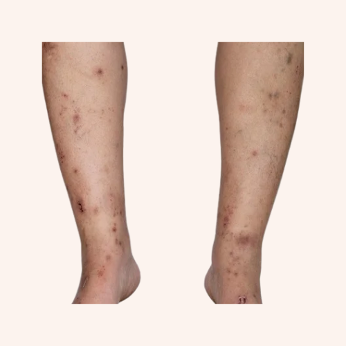 BODY SCARS/DARK SPOTS