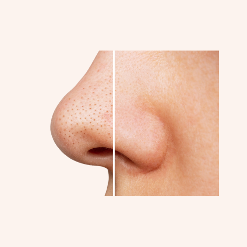 BLACKHEADS